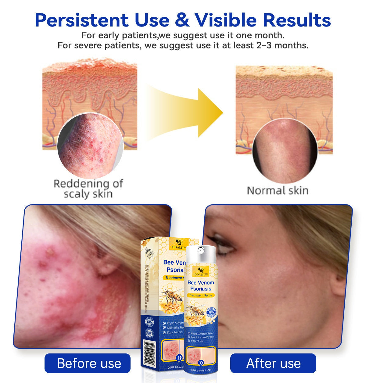 🔥ODALIT™ PsoriaHeal psoriasis Spray pro(🔥 60% off bundle purchase last day limited 🔥)
