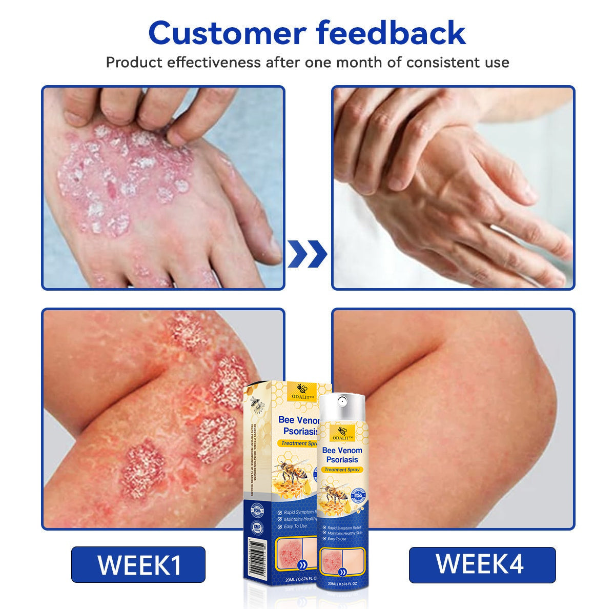 🔥ODALIT™ PsoriaHeal psoriasis Spray pro(🔥 60% off bundle purchase last day limited 🔥)