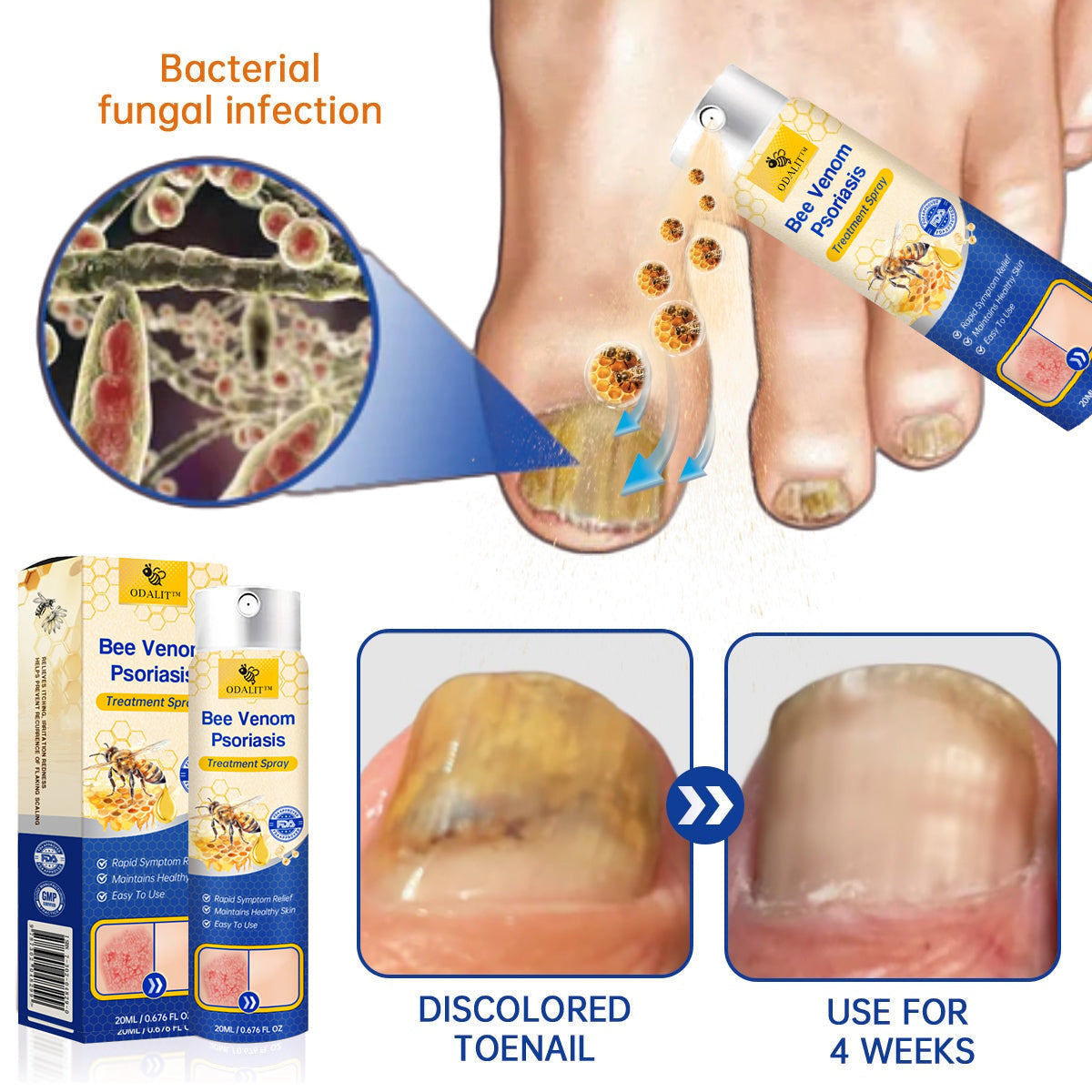 🔥ODALIT™ PsoriaHeal psoriasis Spray pro(🔥 60% off bundle purchase last day limited 🔥)