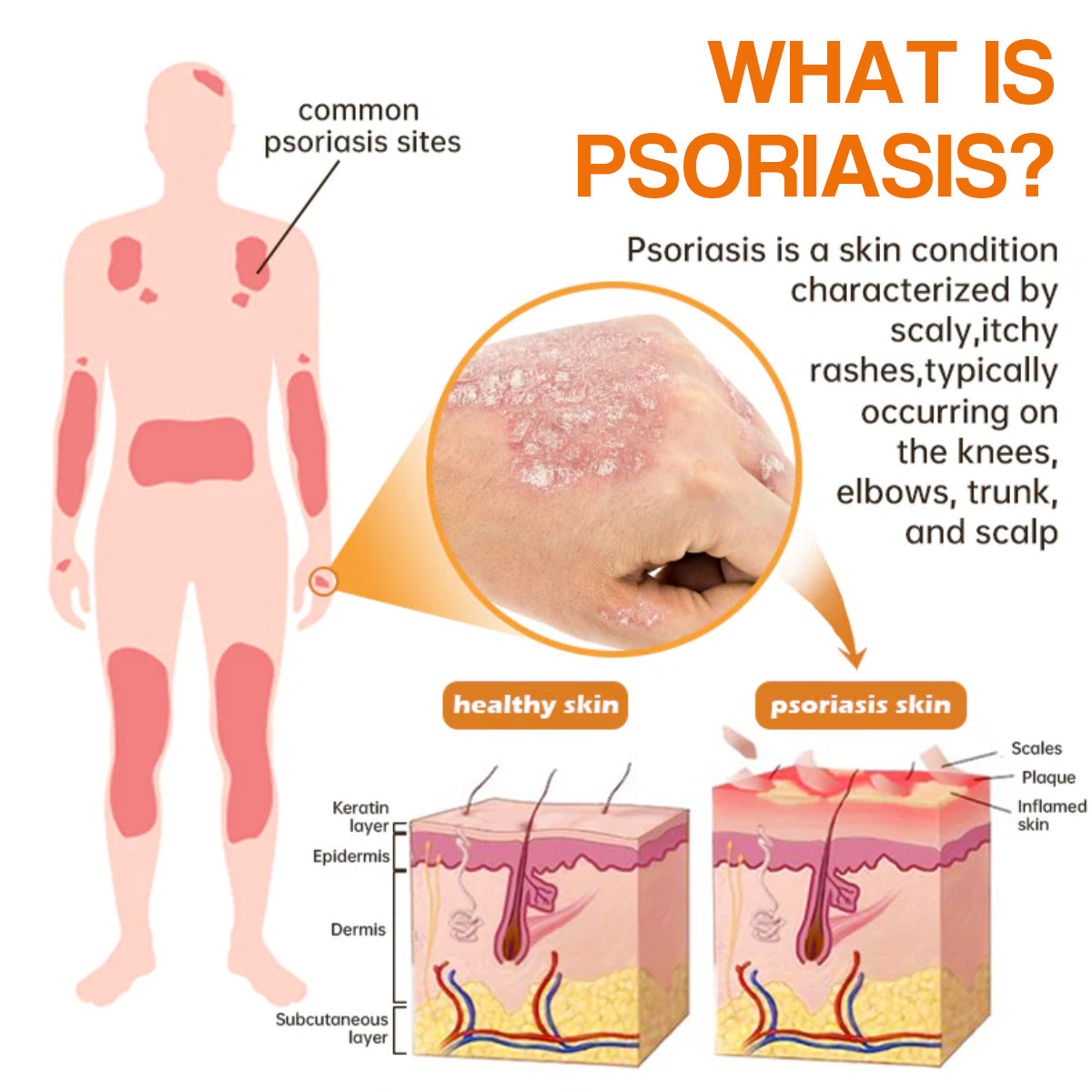 🔥ODALIT™ PsoriaHeal psoriasis Spray pro(🔥 60% off bundle purchase last day limited 🔥)