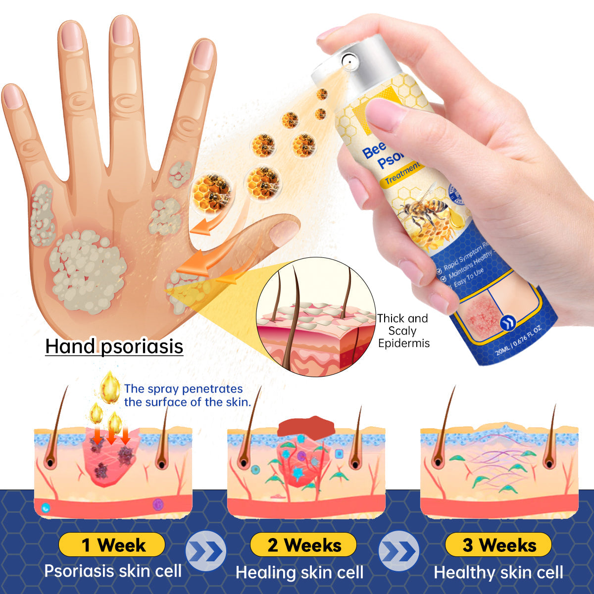🔥ODALIT™ PsoriaHeal psoriasis Spray pro(🔥 60% off bundle purchase last day limited 🔥)