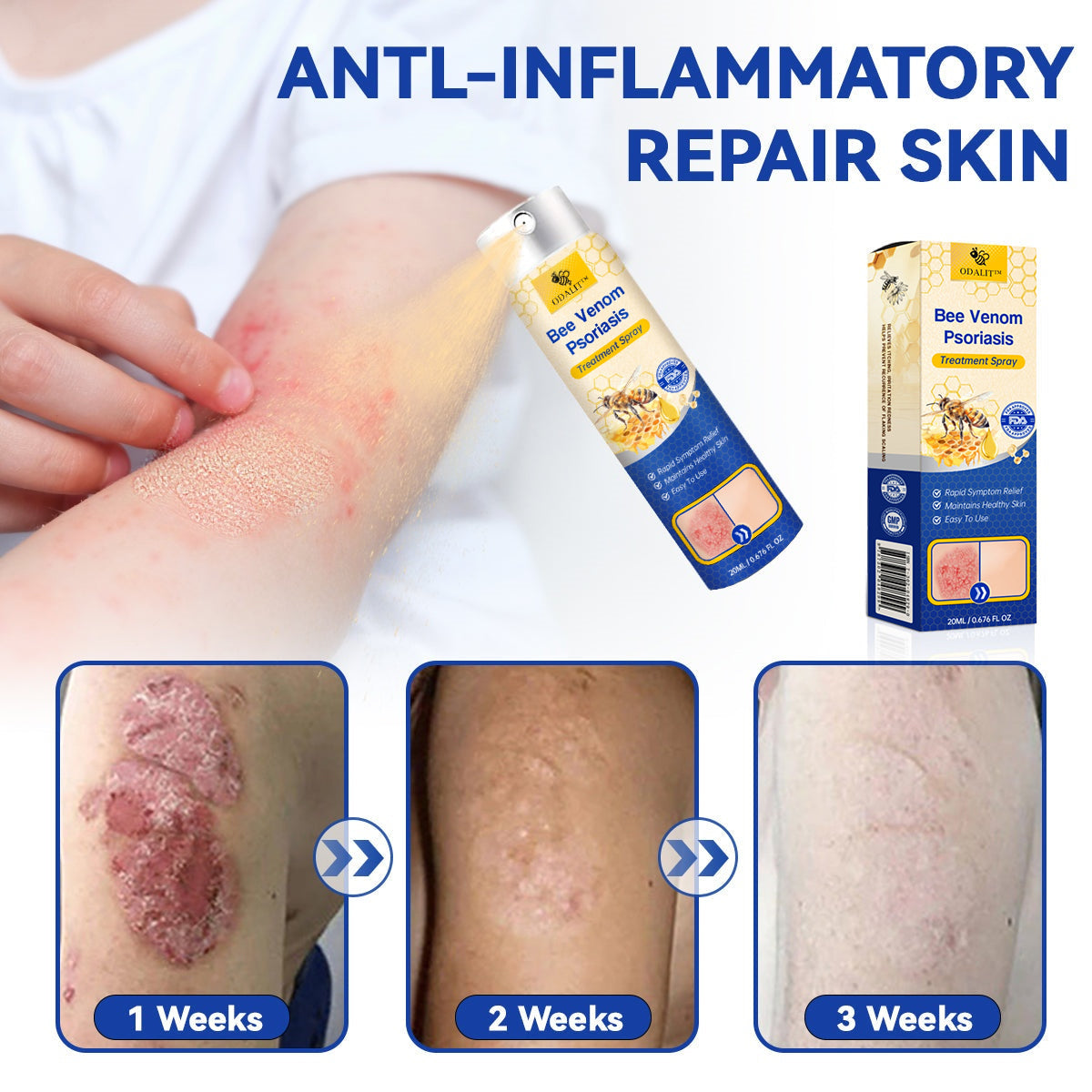 🔥ODALIT™ PsoriaHeal psoriasis Spray pro(🔥 60% off bundle purchase last day limited 🔥)