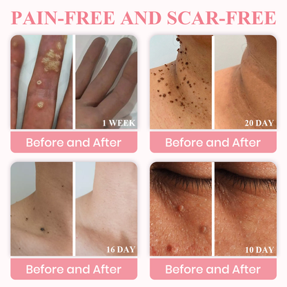 🌿 Negusy™ Dual Acid Wart & Mole Remover✅ Clinically proven ingredients