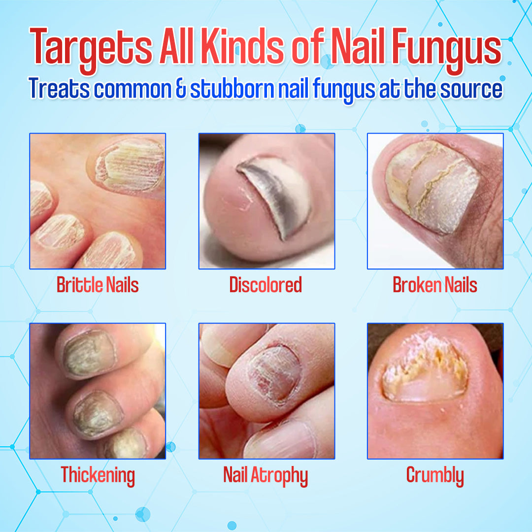 Zakdavi™ Anti-Fungal Nail Repair Patches✨ Say Goodbye to Nail Fungus in Days! 💅🍃