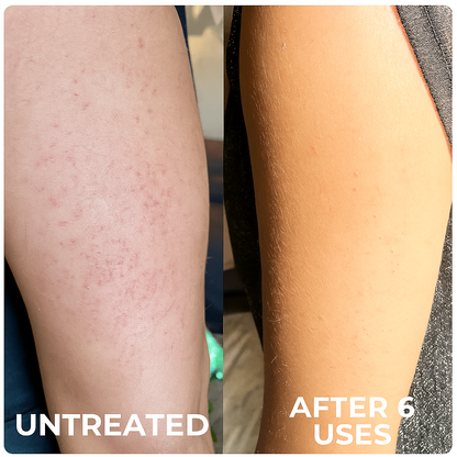Seurico™ SmoothGlow KP Treatment Cream|Target Rough Bumps. Reveal Radiant, Touchably Smooth Skin. ✨💛