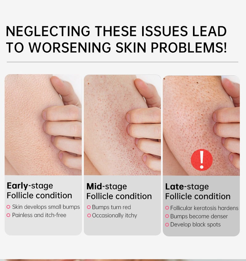 Seurico™ SmoothGlow KP Treatment Cream|Target Rough Bumps. Reveal Radiant, Touchably Smooth Skin. ✨💛
