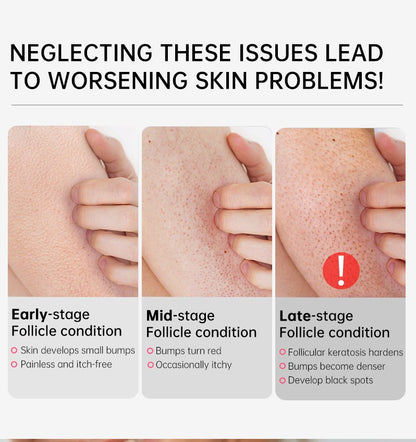 Seurico™ SmoothGlow KP Treatment Cream|Target Rough Bumps. Reveal Radiant, Touchably Smooth Skin. ✨💛