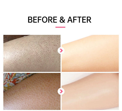 Seurico™ SmoothGlow KP Treatment Cream|Target Rough Bumps. Reveal Radiant, Touchably Smooth Skin. ✨💛
